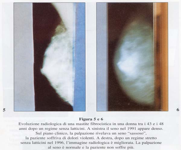 radiografia mastopatia fibrocistica