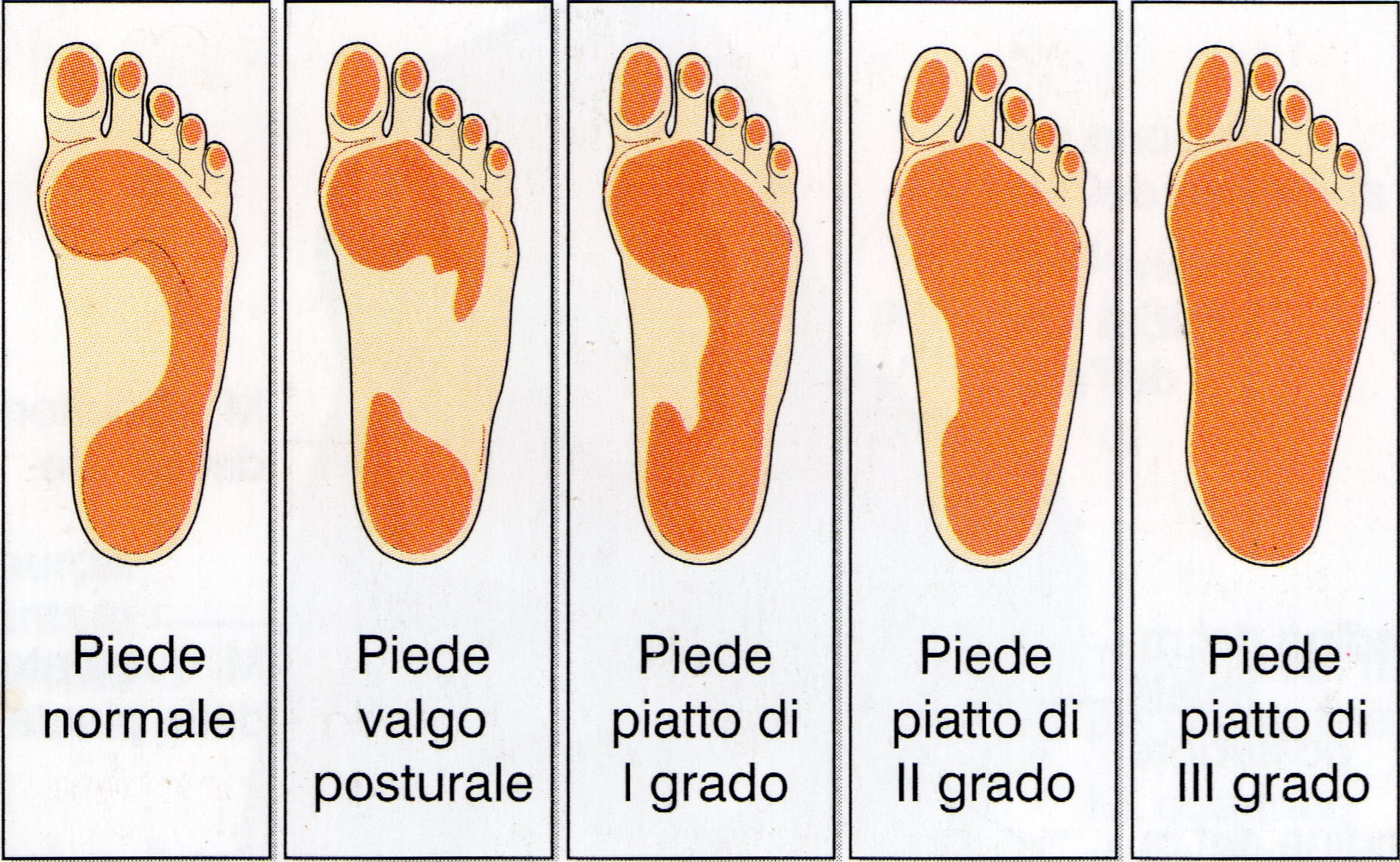 schema piede normale a piede piatto