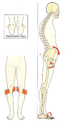 retropiede valgo